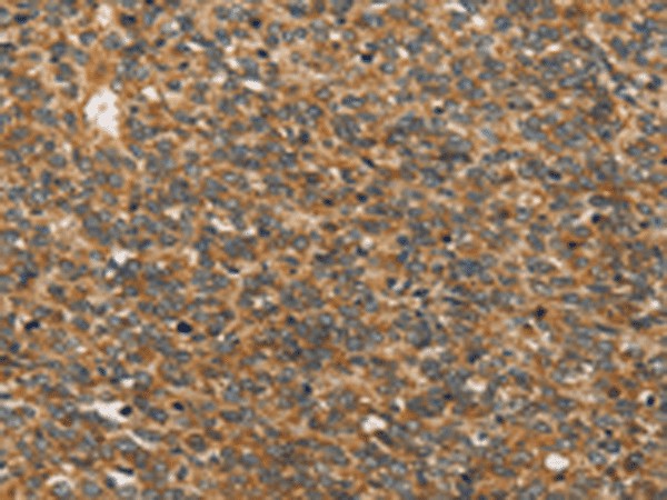 Immunohistochemistry of paraffin-embedded Human ovarian cancer tissue using XPR1 Polyclonal Antibody at dilution of 1:45(×200)