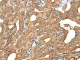 Immunohistochemistry of paraffin-embedded Human thyroid cancer tissue using INF2 Polyclonal Antibody at dilution of 1:40(×200)