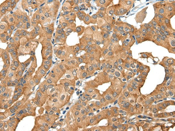Immunohistochemistry of paraffin-embedded Human thyroid cancer tissue using INF2 Polyclonal Antibody at dilution of 1:40(×200)