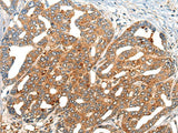 Immunohistochemistry of paraffin-embedded Human liver cancer tissue using NOG Polyclonal Antibody at dilution of 1:40(×200)