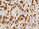 Immunohistochemistry of paraffin-embedded Human liver cancer tissue using SAA1 Polyclonal Antibody at dilution of 1:70(×200)