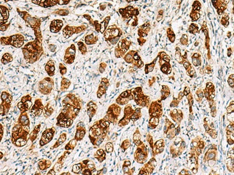 Immunohistochemistry of paraffin-embedded Human liver cancer tissue using SAA1 Polyclonal Antibody at dilution of 1:70(×200)