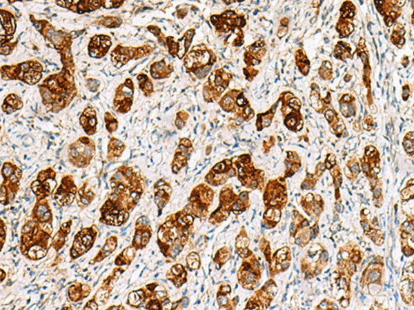 Immunohistochemistry of paraffin-embedded Human liver cancer tissue using SAA1 Polyclonal Antibody at dilution of 1:70(×200)