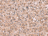 Immunohistochemistry of paraffin-embedded Human liver cancer tissue using SHC4 Polyclonal Antibody at dilution of 1:90(×200)