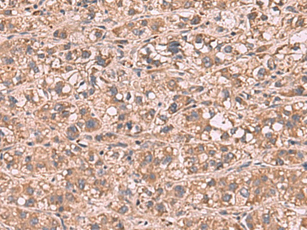 Immunohistochemistry of paraffin-embedded Human liver cancer tissue using SHC4 Polyclonal Antibody at dilution of 1:90(×200)