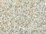 Immunohistochemistry of paraffin-embedded Human liver cancer tissue using KIF21B Polyclonal Antibody at dilution of 1:40(×200)