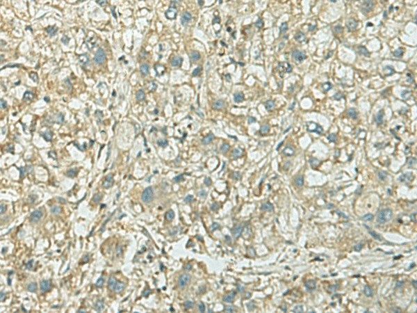 Immunohistochemistry of paraffin-embedded Human liver cancer tissue using KIF21B Polyclonal Antibody at dilution of 1:40(×200)