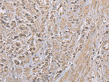 Immunohistochemistry of paraffin-embedded Human prost at e cancer tissue using ZBTB2 Polyclonal Antibody at dilution of 1:50(×200)