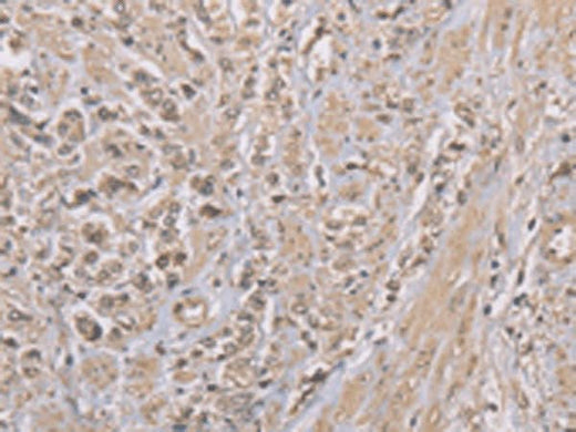 Immunohistochemistry of paraffin-embedded Human prost at e cancer tissue using ZBTB2 Polyclonal Antibody at dilution of 1:50(×200)