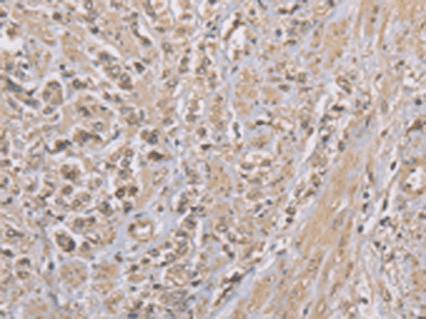 Immunohistochemistry of paraffin-embedded Human prost at e cancer tissue using ZBTB2 Polyclonal Antibody at dilution of 1:50(×200)