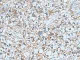 Immunohistochemistry of paraffin-embedded Human liver cancer tissue using CNTN4 Polyclonal Antibody at dilution of 1:60(×200)