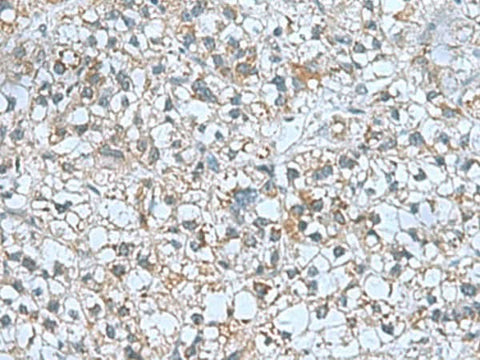 Immunohistochemistry of paraffin-embedded Human liver cancer tissue using CNTN4 Polyclonal Antibody at dilution of 1:60(×200)