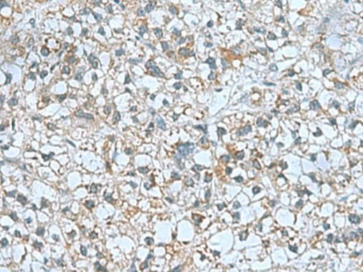 Immunohistochemistry of paraffin-embedded Human liver cancer tissue using CNTN4 Polyclonal Antibody at dilution of 1:60(×200)
