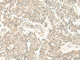 Immunohistochemistry of paraffin-embedded Human lung cancer tissue using GINS2 Polyclonal Antibody at dilution of 1:50(×200)