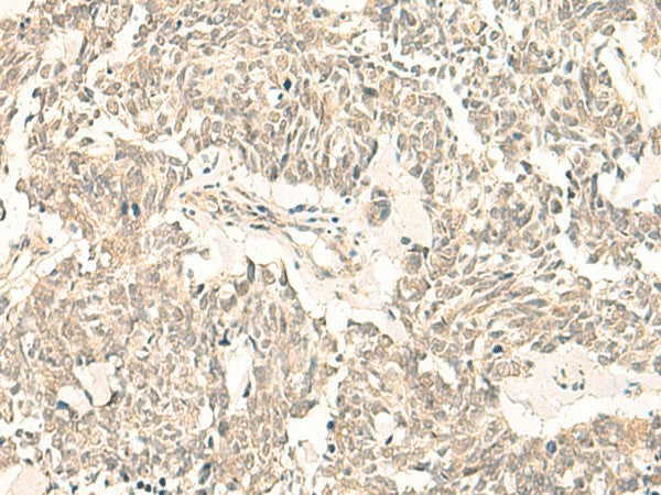 Immunohistochemistry of paraffin-embedded Human lung cancer tissue using GINS2 Polyclonal Antibody at dilution of 1:50(×200)
