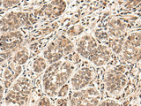 Immunohistochemistry of paraffin-embedded Human esophagus cancer tissue using HGH1 Polyclonal Antibody at dilution of 1:45(×200)