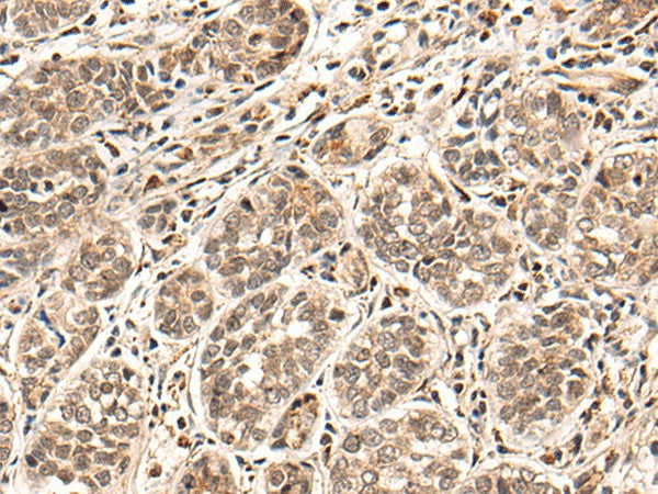 Immunohistochemistry of paraffin-embedded Human esophagus cancer tissue using HGH1 Polyclonal Antibody at dilution of 1:45(×200)