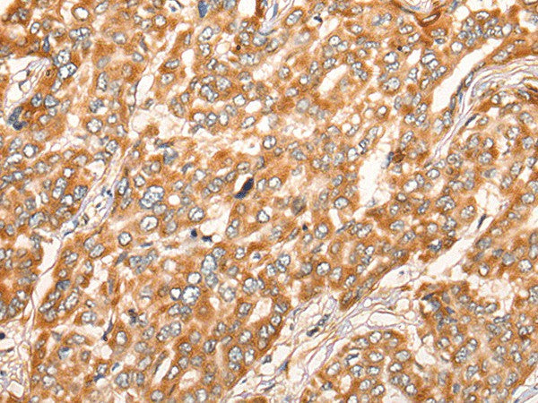 Immunohistochemistry of paraffin-embedded Human liver cancer tissue using ZMYND10 Polyclonal Antibody at dilution of 1:35(×200)