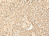 Immunohistochemistry of paraffin-embedded Human ovarian cancer tissue using SMNDC1 Polyclonal Antibody at dilution of 1:50(×200)