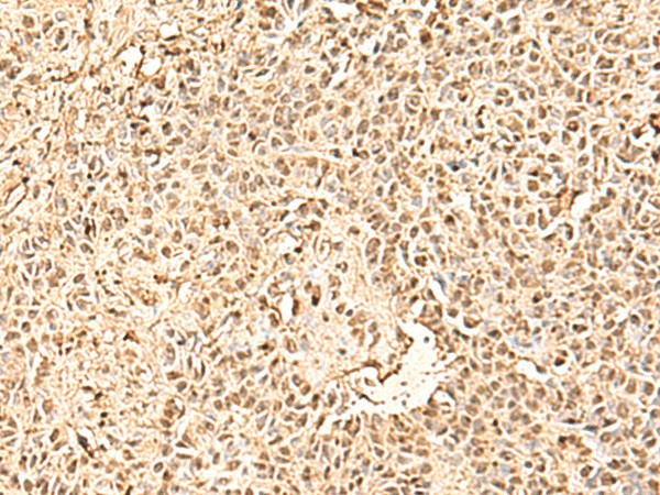Immunohistochemistry of paraffin-embedded Human ovarian cancer tissue using SMNDC1 Polyclonal Antibody at dilution of 1:50(×200)