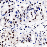 Immunohistochemistry analysis of paraffin-embedded human liver cancer using DNMT1 Polyclonal Antibody at dilution of 1:300.