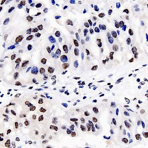 Immunohistochemistry analysis of paraffin-embedded human liver cancer using DNMT1 Polyclonal Antibody at dilution of 1:300.