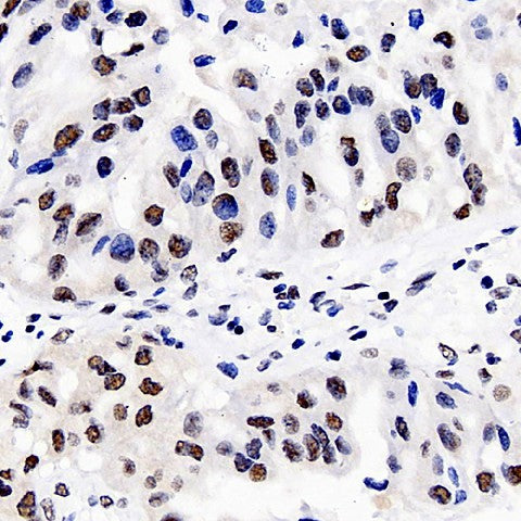 Immunohistochemistry analysis of paraffin-embedded human liver cancer using DNMT1 Polyclonal Antibody at dilution of 1:300.