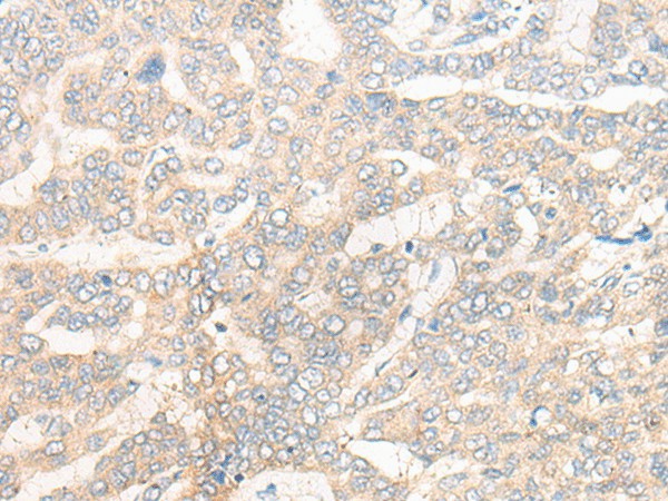 Immunohistochemistry of paraffin-embedded Human liver cancer tissue using CYB5R3 Polyclonal Antibody at dilution of 1:50(×200)