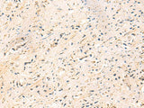 Immunohistochemistry of paraffin-embedded Human prost at e cancer tissue using IP6K3 Polyclonal Antibody at dilution of 1:50(×200)