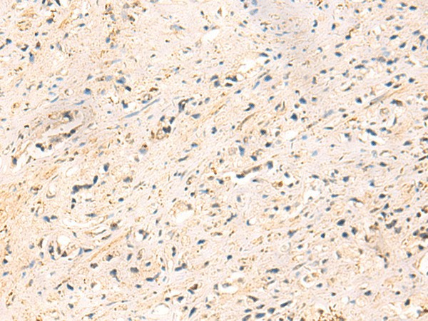 Immunohistochemistry of paraffin-embedded Human prost at e cancer tissue using IP6K3 Polyclonal Antibody at dilution of 1:50(×200)