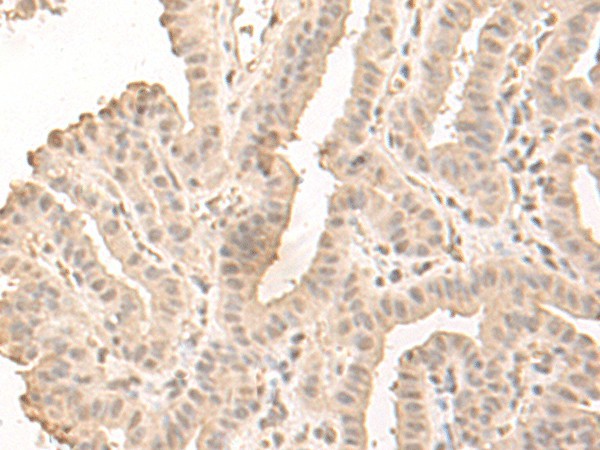 Immunohistochemistry of paraffin-embedded Human thyroid cancer tissue using SAP130 Polyclonal Antibody at dilution of 1:50(×200)