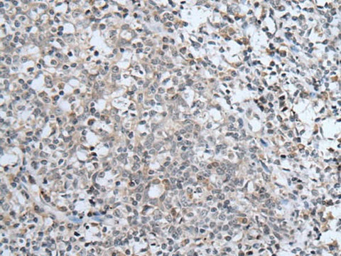 Immunohistochemistry of paraffin-embedded Human tonsil tissue using ABCA6 Polyclonal Antibody at dilution of 1:40(×200)