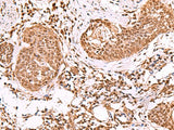 Immunohistochemistry of paraffin-embedded Human esophagus cancer tissue using IP6K1 Polyclonal Antibody at dilution of 1:55(×200)