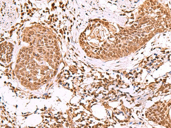 Immunohistochemistry of paraffin-embedded Human esophagus cancer tissue using IP6K1 Polyclonal Antibody at dilution of 1:55(×200)
