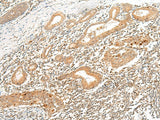 Immunohistochemistry of paraffin-embedded Human esophagus cancer tissue using HLA-G Polyclonal Antibody at dilution of 1:45(×200)