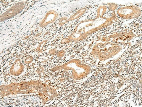 Immunohistochemistry of paraffin-embedded Human esophagus cancer tissue using HLA-G Polyclonal Antibody at dilution of 1:45(×200)