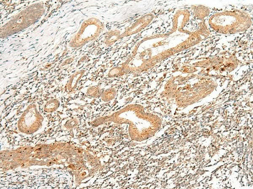 Immunohistochemistry of paraffin-embedded Human esophagus cancer tissue using HLA-G Polyclonal Antibody at dilution of 1:45(×200)