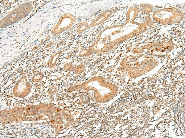 Immunohistochemistry of paraffin-embedded Human esophagus cancer tissue using HLA-G Polyclonal Antibody at dilution of 1:45(×200)