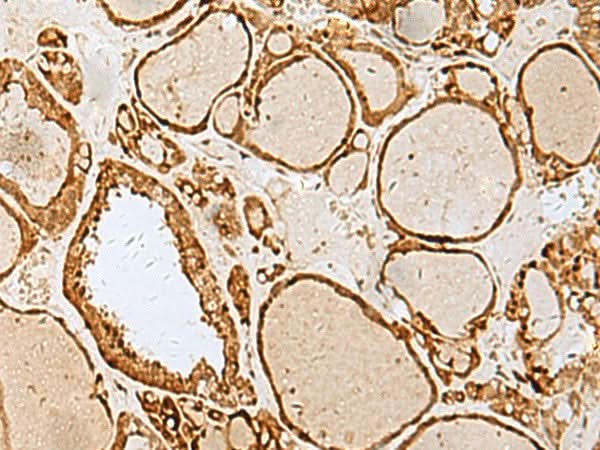 Immunohistochemistry of paraffin-embedded Human thyroid cancer tissue using LYRM1 Polyclonal Antibody at dilution of 1:40(×200)