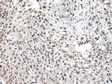 Immunohistochemistry of paraffin-embedded Human lung cancer tissue using UBE2E3 Polyclonal Antibody at dilution of 1:40(×200)