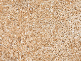 Immunohistochemistry of paraffin-embedded Human liver cancer tissue using HIRIP3 Polyclonal Antibody at dilution of 1:60(×200)