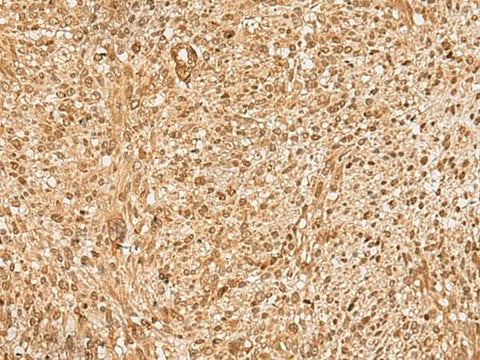 Immunohistochemistry of paraffin-embedded Human liver cancer tissue using HIRIP3 Polyclonal Antibody at dilution of 1:60(×200)