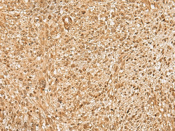 Immunohistochemistry of paraffin-embedded Human liver cancer tissue using HIRIP3 Polyclonal Antibody at dilution of 1:60(×200)