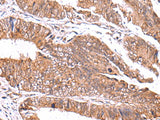 Immunohistochemistry of paraffin-embedded Human colorectal cancer tissue using GATM Polyclonal Antibody at dilution of 1:70(×200)