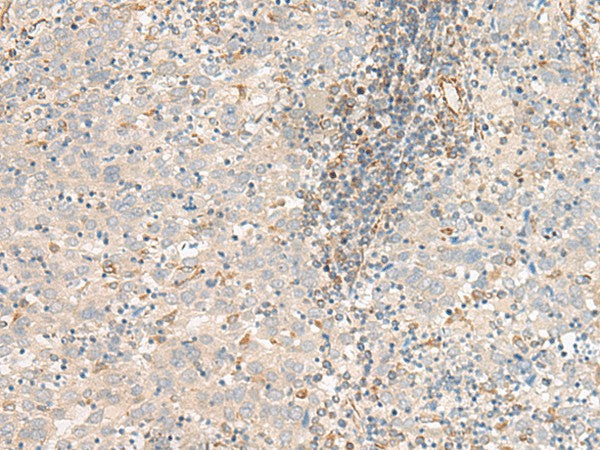 Immunohistochemistry of paraffin-embedded Human cervical cancer tissue using FER Polyclonal Antibody at dilution of 1:80(×200)