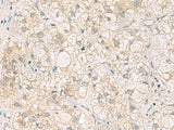 Immunohistochemistry of paraffin-embedded Human liver cancer tissue using LRAT Polyclonal Antibody at dilution of 1:50(×200)