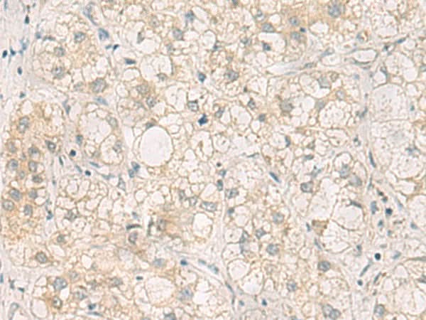 Immunohistochemistry of paraffin-embedded Human liver cancer tissue using LRAT Polyclonal Antibody at dilution of 1:50(×200)