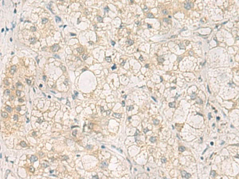 Immunohistochemistry of paraffin-embedded Human liver cancer tissue using LRAT Polyclonal Antibody at dilution of 1:50(×200)