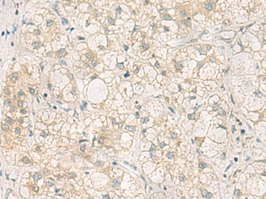 Immunohistochemistry of paraffin-embedded Human liver cancer tissue using LRAT Polyclonal Antibody at dilution of 1:50(×200)