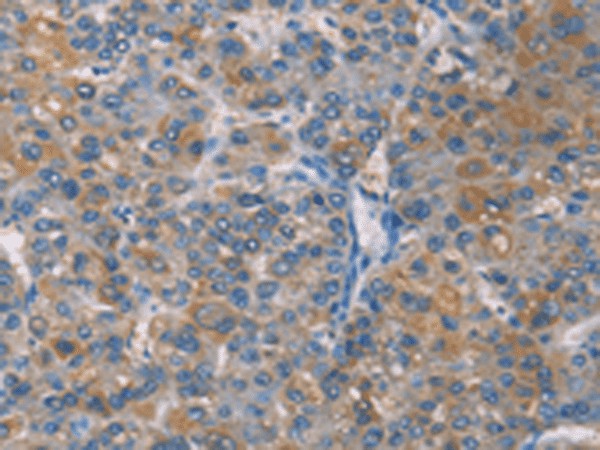 Immunohistochemistry of paraffin-embedded Human liver cancer tissue using ZBTB1 Polyclonal Antibody at dilution of 1:50(×200)
